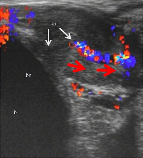 squrit men|Male squirting: Analysis of one case using color Doppler ...